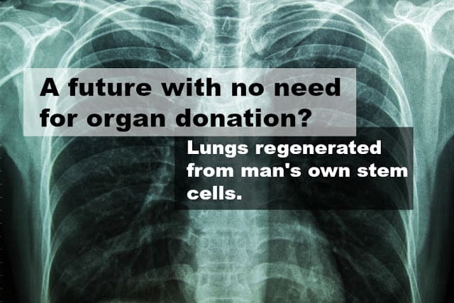 Goodbye Organ Donation – Scientists Generated Healthy Lung Tissue From Man’s Own Stem Cells