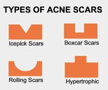 How to Get Rid of Acne Scars How to Deal With the Scars Of Acne! Learn Some Treatments That’ll Help