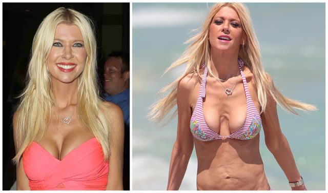 In The Race For Beauty Standards: Celebrities With Unsuccessful Breast Reconstruction&#8230;