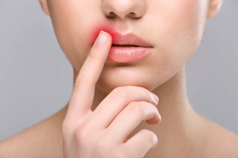 Kiss Of the Devil: How To Quickly Get Rid Of the Manifestations Of Herpes at Home