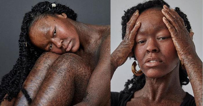 Girl With Scaly Skin Became A Model