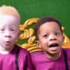 The twin of a dark-skinned baby turned out to be a red-haired albino - what unusual brothers look like 58